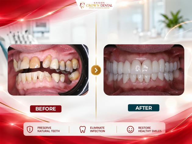 Crown & Bridge Before & After