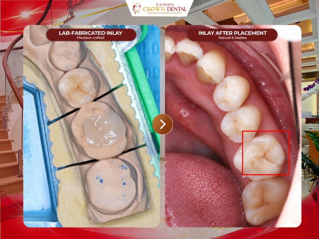 Inlays lab and after placement