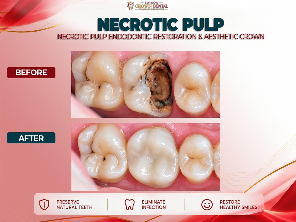 Root Canal Before & after