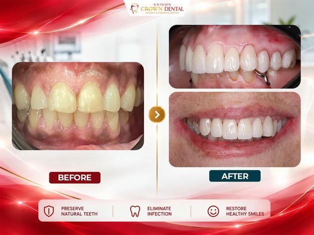 Posterior Crown & Bridge Before & After