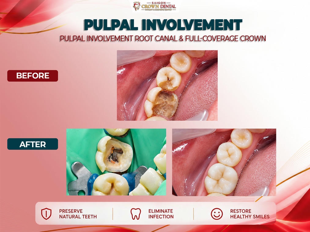Root Canal Before & after