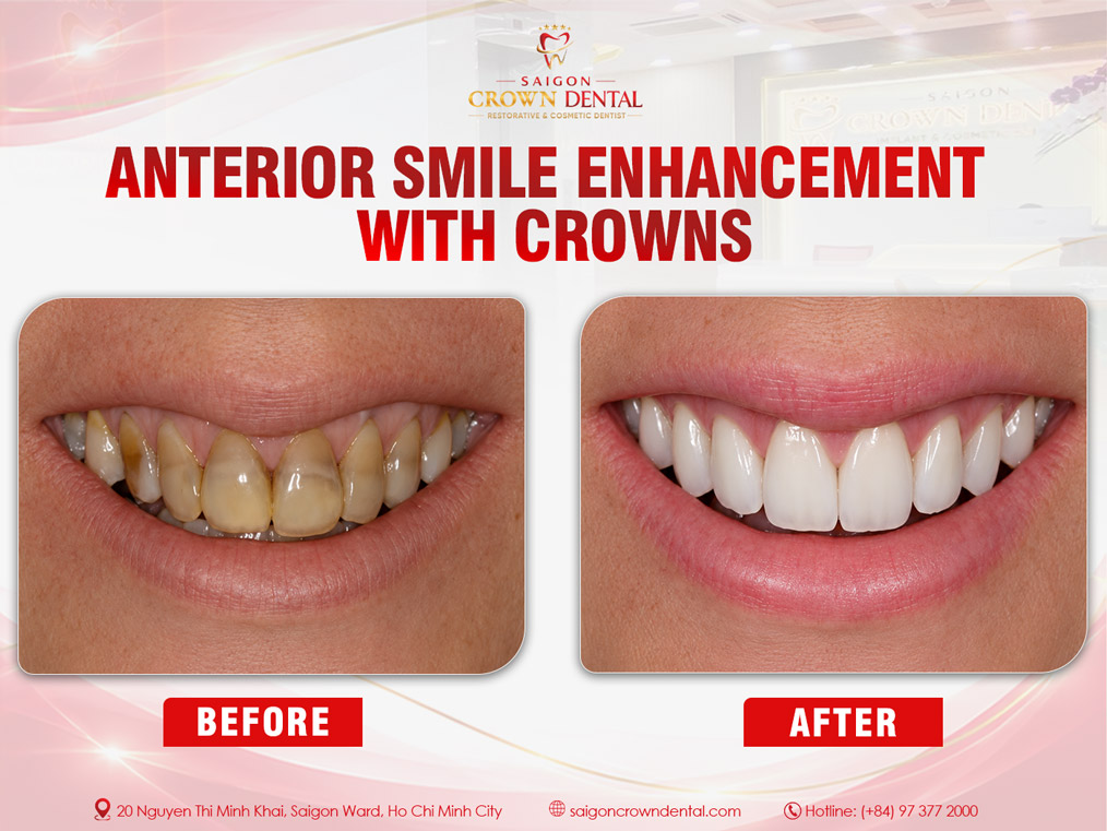 Translucent, Discolored Teeth Crown Restoration – Saigon Crown Dental