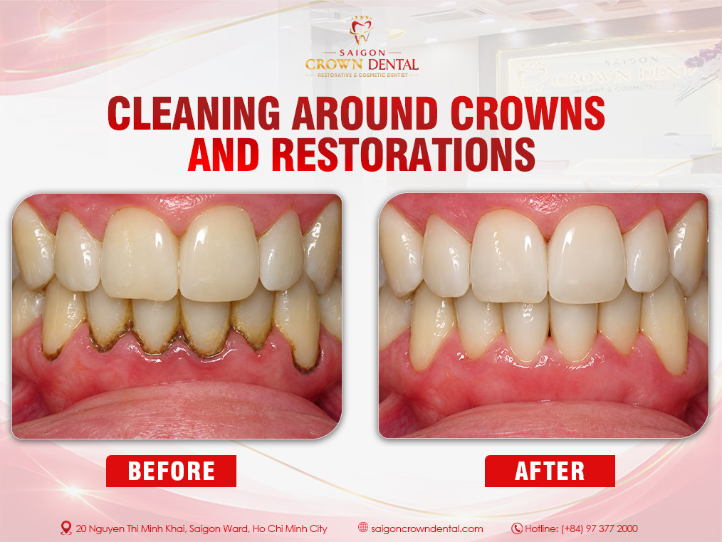 Teeth Cleaning Before and After