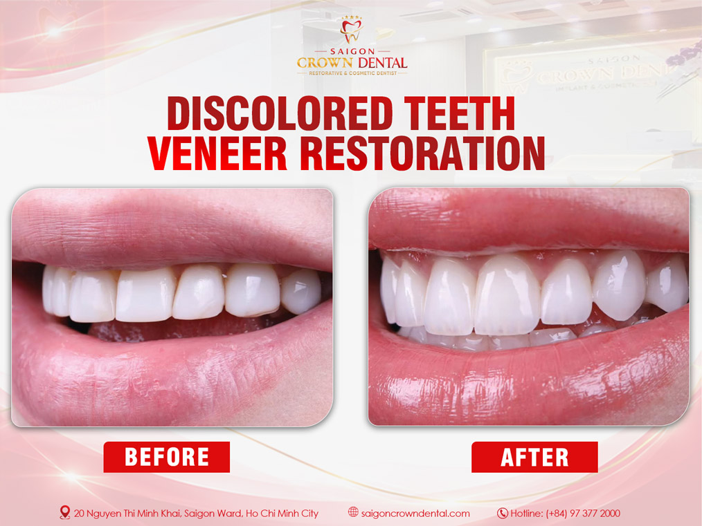 Mildly Discolored Teeth Veneer Restoration – Saigon Crown Dental