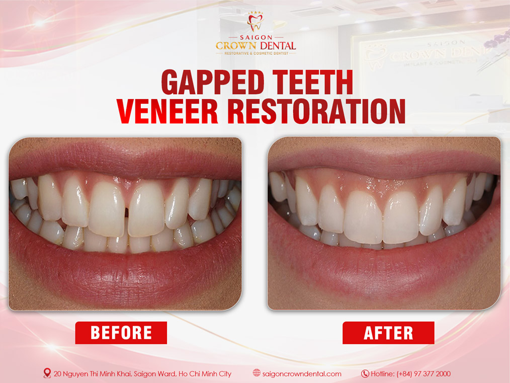 Gapped Teeth Veneer Restoration – Saigon Crown Dental