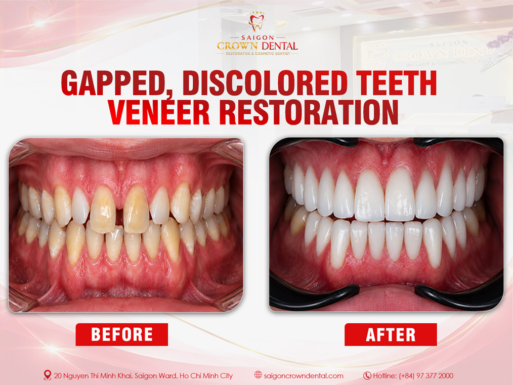 Gapped Teeth Veneer Restoration – Saigon Crown Dental