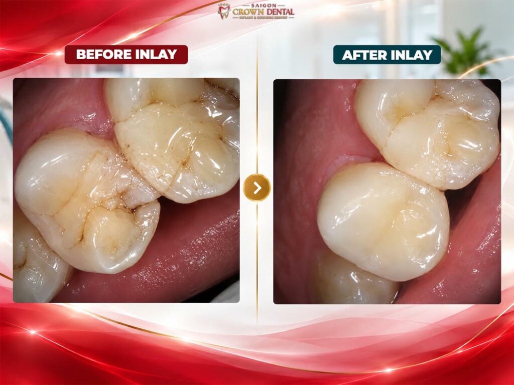 inlays dental before after