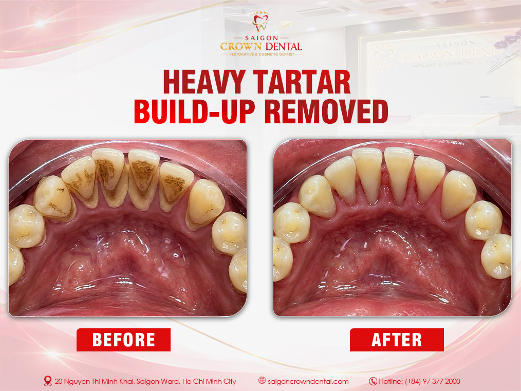 Teeth Cleaning Before and After