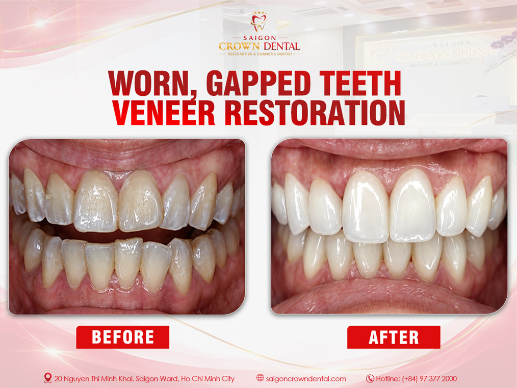 Worn, Gapped Teeth Veneer Restoration – Saigon Crown Dental